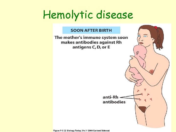 Hemolytic disease Figure 7. 5 (2) 