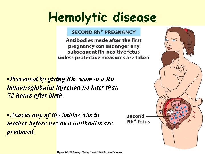 Hemolytic disease Figure 7. 5 (3) • Prevented by giving Rh- women a Rh