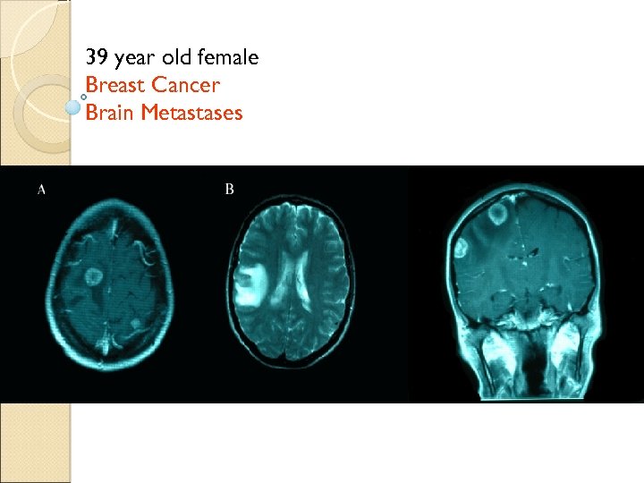 39 year old female Breast Cancer Brain Metastases ` 