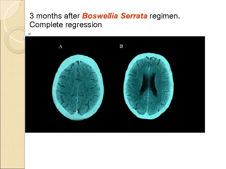 3 months after Boswellia Serrata regimen. Complete regression 