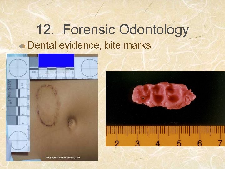 12. Forensic Odontology Dental evidence, bite marks 