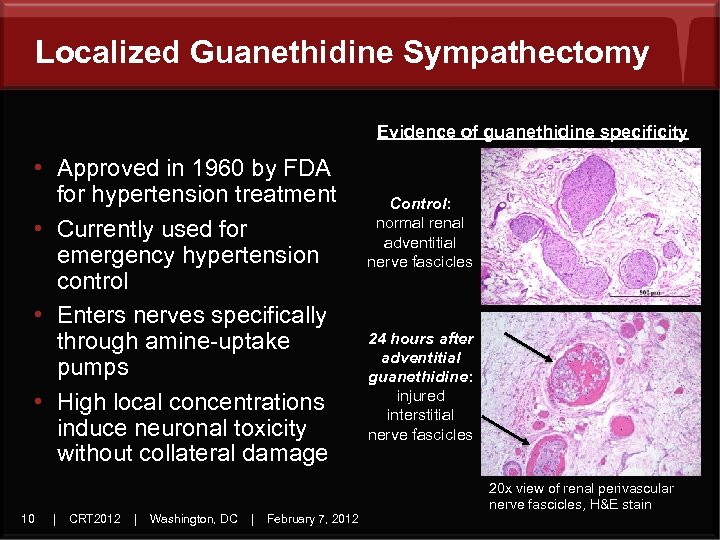 Localized Guanethidine Sympathectomy Evidence of guanethidine specificity • Approved in 1960 by FDA for