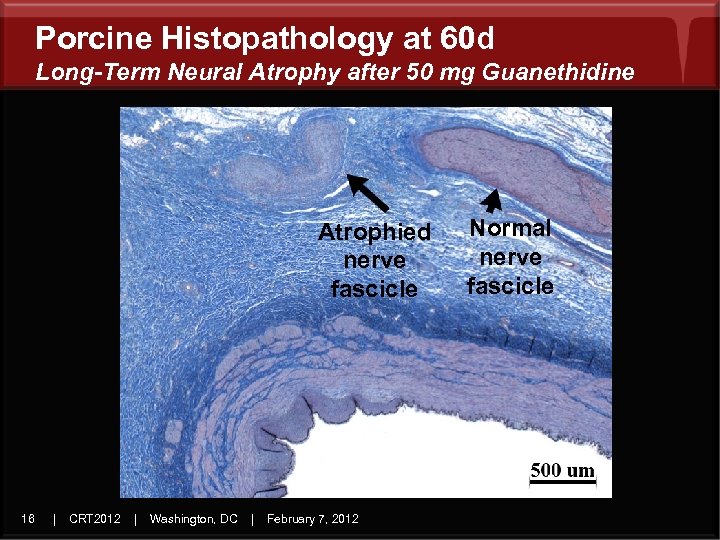 Porcine Histopathology at 60 d Long-Term Neural Atrophy after 50 mg Guanethidine Atrophied nerve