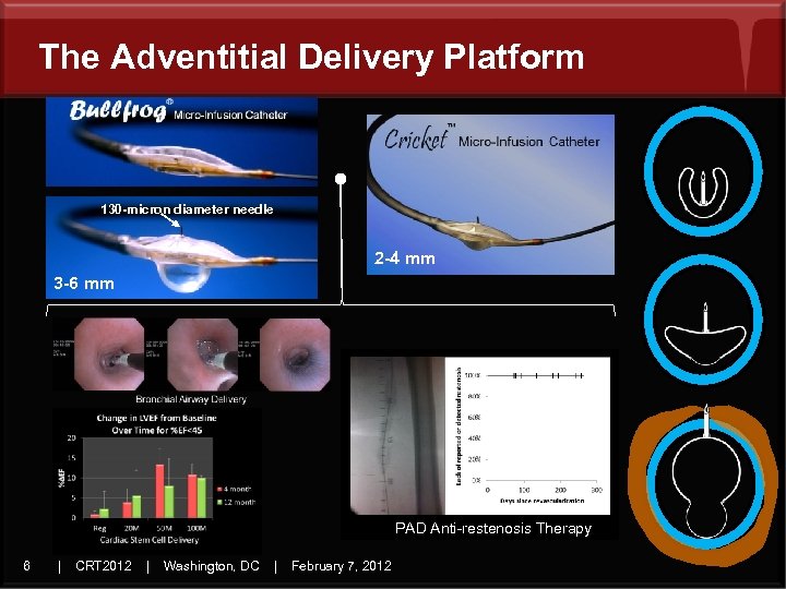 The Adventitial Delivery Platform 130 -micron diameter needle 2 -4 mm 3 -6 mm