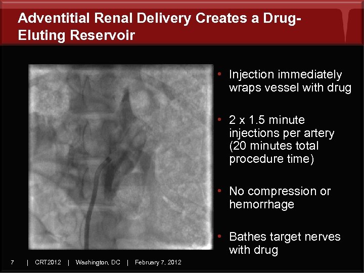 Adventitial Renal Delivery Creates a Drug. Eluting Reservoir • Injection immediately wraps vessel with