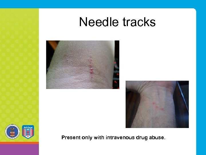 Needle tracks Present only with intravenous drug abuse. 