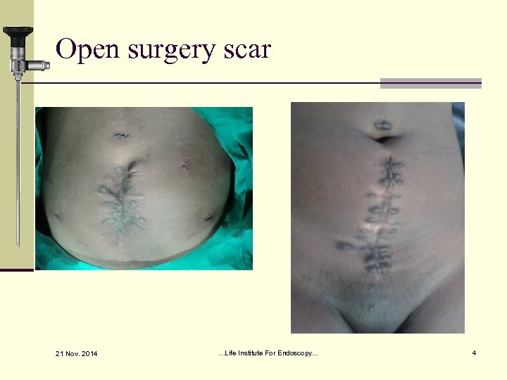 Open surgery scar 21 Nov. 2014 . . . Life Institute For Endoscopy. .
