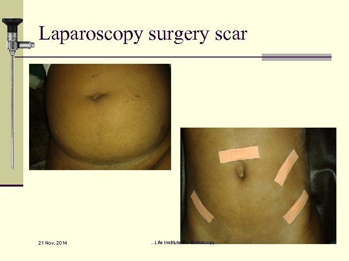 Laparoscopy surgery scar 21 Nov. 2014 . . . Life Institute For Endoscopy. .