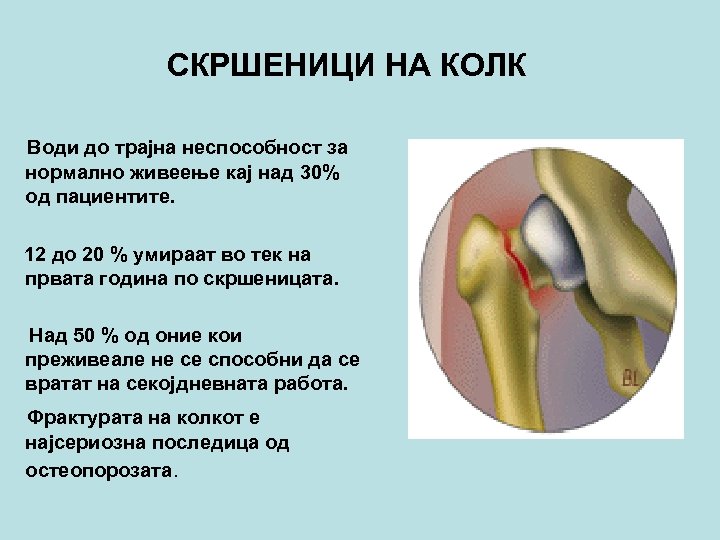 СКРШЕНИЦИ НА КОЛК Води до трајна неспособност за нормално живеење кај над 30% од