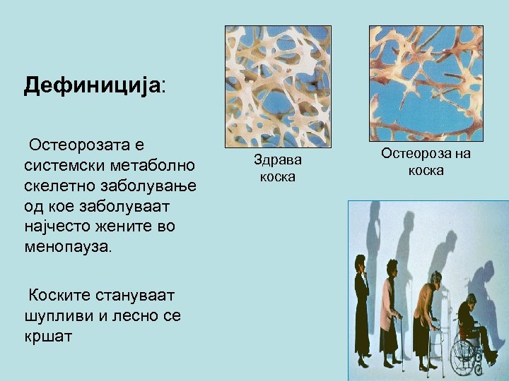 Дефиниција: Остеорозата е системски метаболно скелетно заболување од кое заболуваат најчесто жените во менопауза.