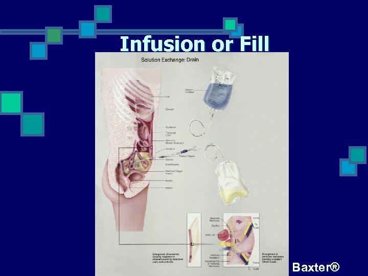 Infusion or Fill Baxter® 