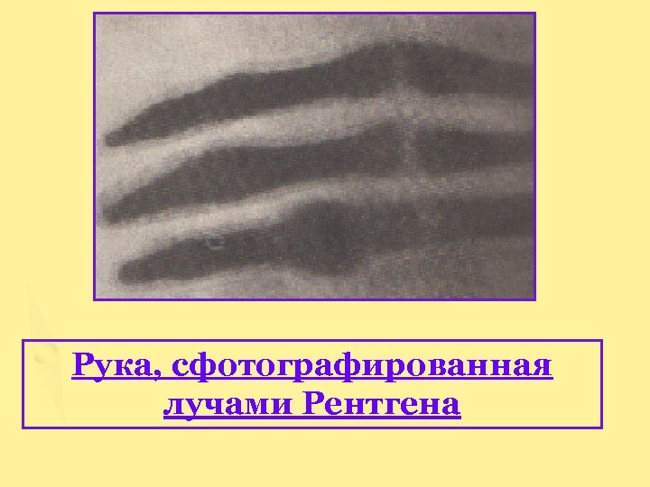 Рука, сфотографированная лучами Рентгена 