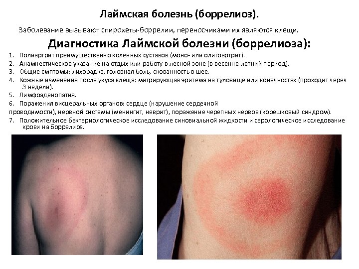 Лаймская болезнь (боррелиоз). Заболевание вызывают спирохеты-боррелии, переносчиками их являются клещи. 1. 2. 3. 4.