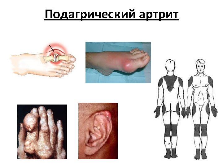 Подагрический артрит 