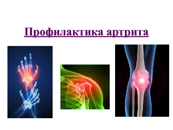 Профилактика артрита 