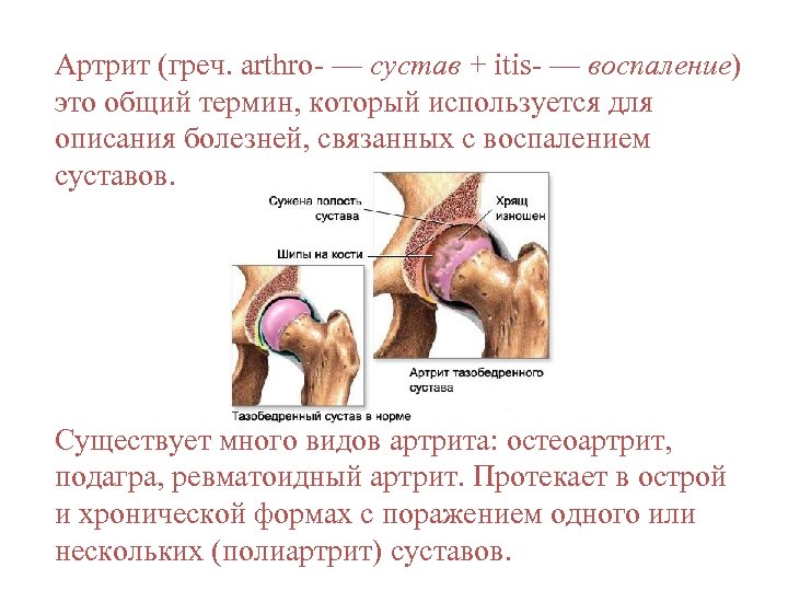 Артрит (греч. arthro- — сустав + itis- — воспаление) это общий термин, который используется