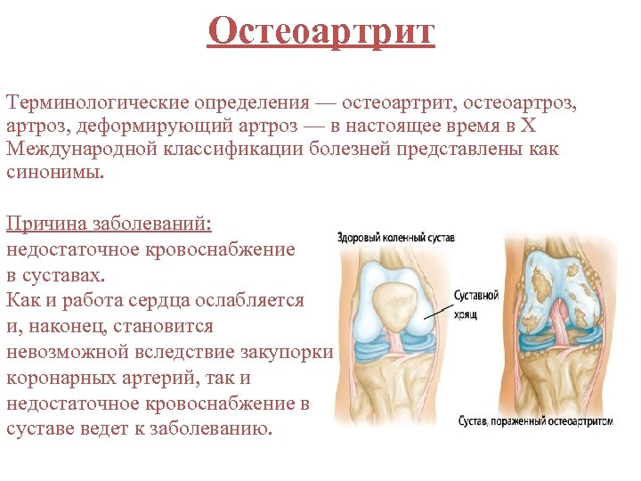 Остеоартрит Терминологические определения — остеоартрит, остеоартроз, деформирующий артроз — в настоящее время в X