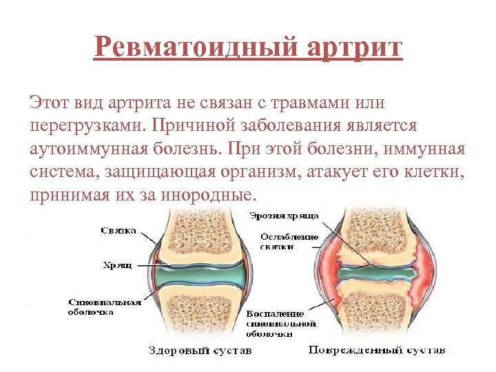Ревматоидный артрит Этот вид артрита не связан с травмами или перегрузками. Причиной заболевания является