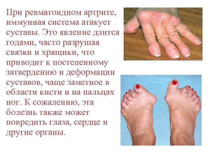 При ревматоидном артрите, иммунная система атакует суставы. Это явление длится годами, часто разрушая связки