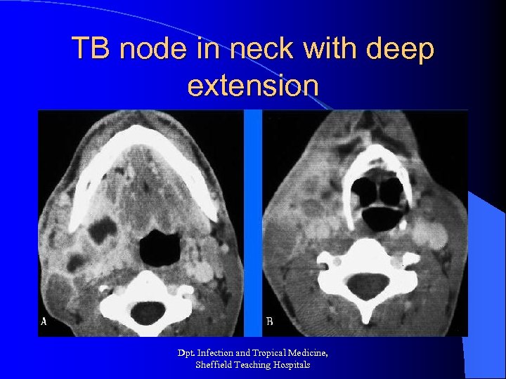 TB node in neck with deep extension Dpt. Infection and Tropical Medicine, Sheffield Teaching