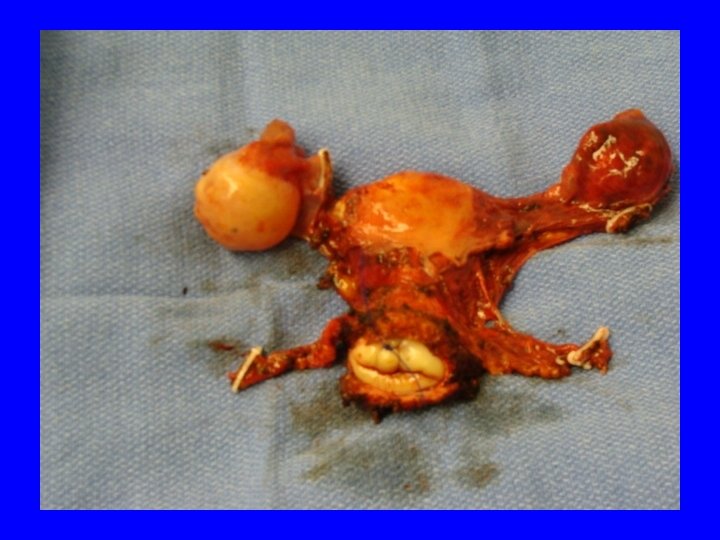 5 year Survival • • Stage III Stage IV 70% 51% 33% 17% 