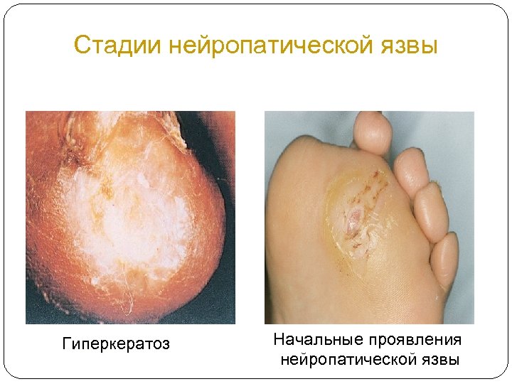 Стадии нейропатической язвы Гиперкератоз Начальные проявления нейропатической язвы 