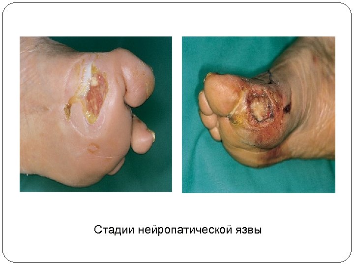 Стадии нейропатической язвы 