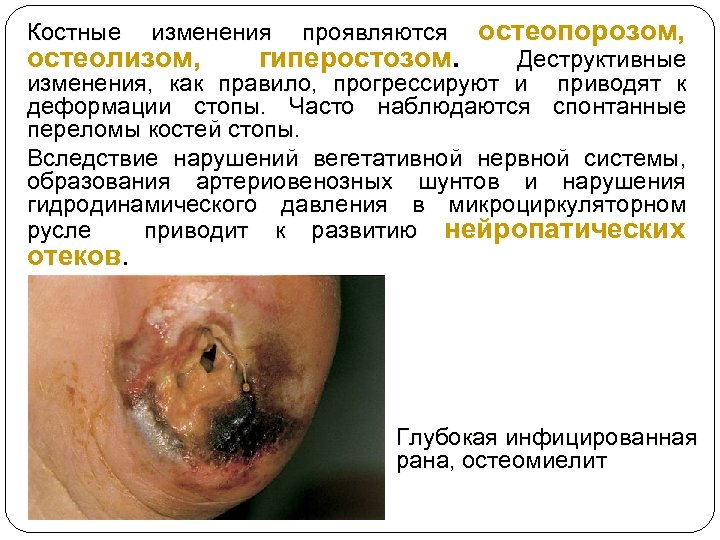 Костные изменения остеолизом, проявляются гиперостозом. остеопорозом, Деструктивные изменения, как правило, прогрессируют и приводят к
