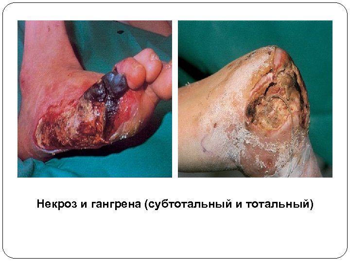 Некроз и гангрена (субтотальный и тотальный) 