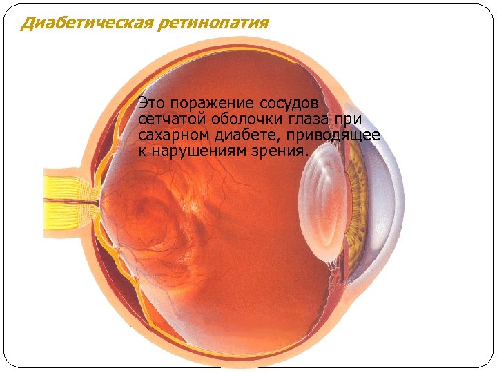 Диабетическая ретинопатия Это поражение сосудов сетчатой оболочки глаза при сахарном диабете, приводящее к нарушениям
