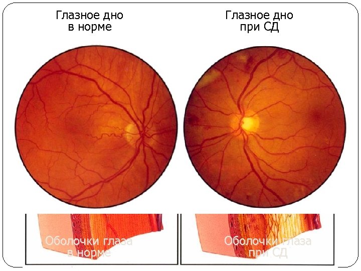 Глазное дно в норме Оболочки глаза в норме Глазное дно при СД Оболочки глаза