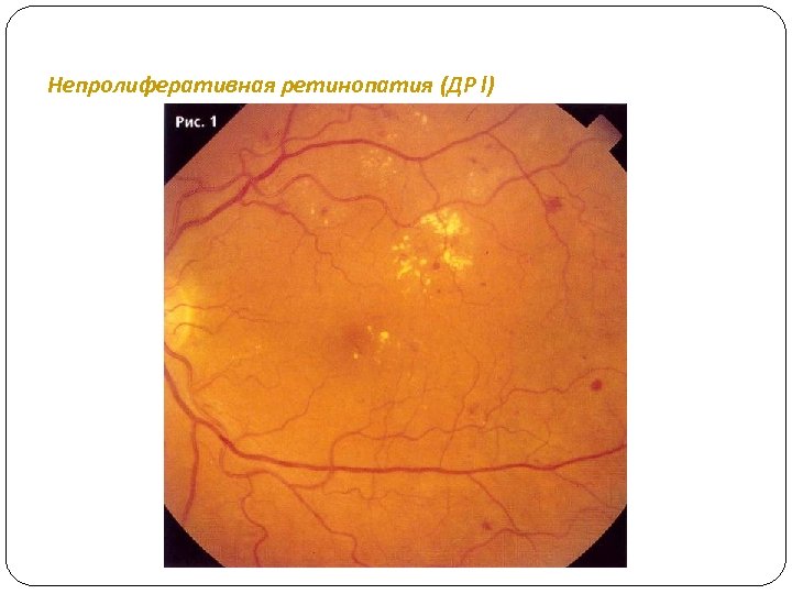 Непролиферативная ретинопатия (ДР I) 