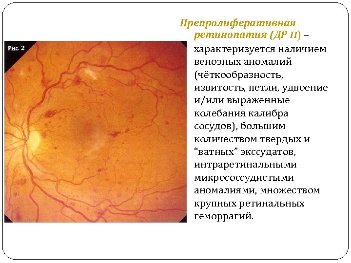 Препролиферативная ретинопатия (ДР II) – характеризуется наличием венозных аномалий (чёткообразность, извитость, петли, удвоение и/или