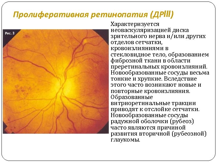 Пролиферативная ретинопатия (ДРIII) Характеризуется неоваскуляризацией диска зрительного нерва и/или других отделов сетчатки, кровоизлияниями в