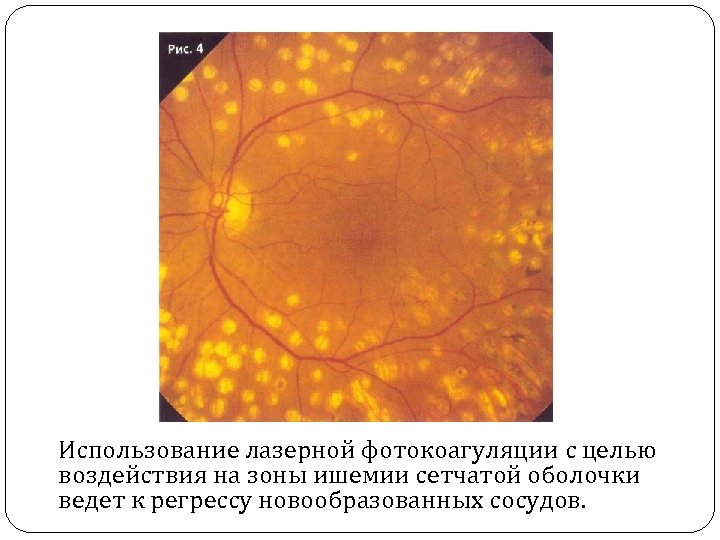 Использование лазерной фотокоагуляции с целью воздействия на зоны ишемии сетчатой оболочки ведет к регрессу