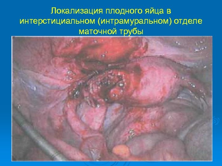 Локализация плодного яйца в интерстициальном (интрамуральном) отделе маточной трубы 