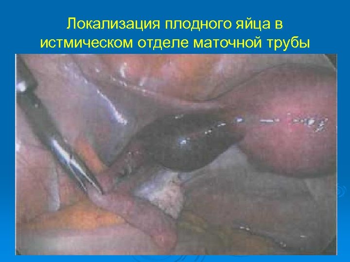 Локализация плодного яйца в истмическом отделе маточной трубы 