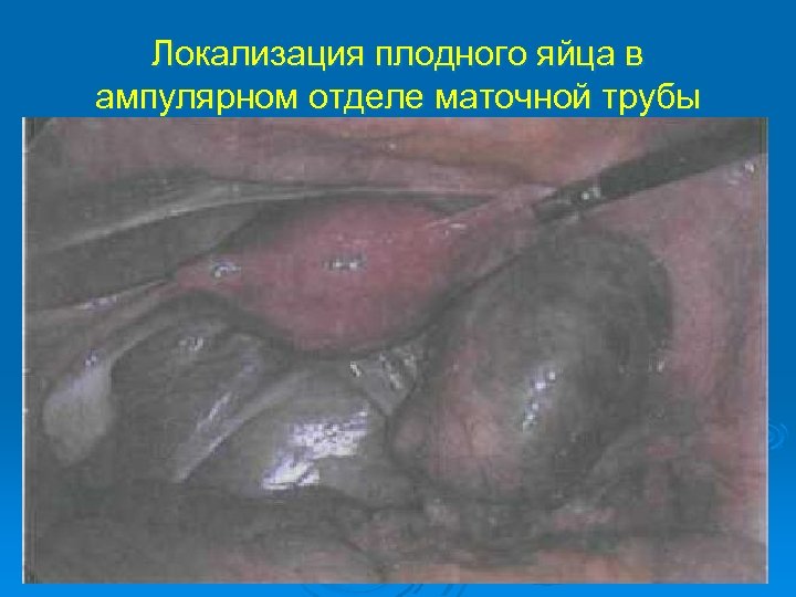 Локализация плодного яйца в ампулярном отделе маточной трубы 