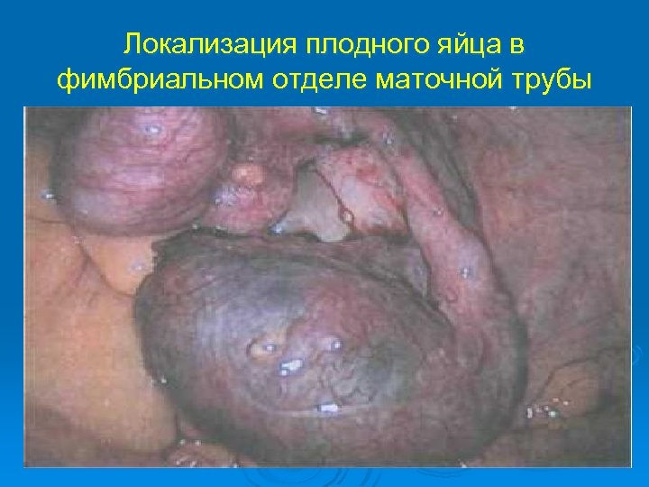 Локализация плодного яйца в фимбриальном отделе маточной трубы 
