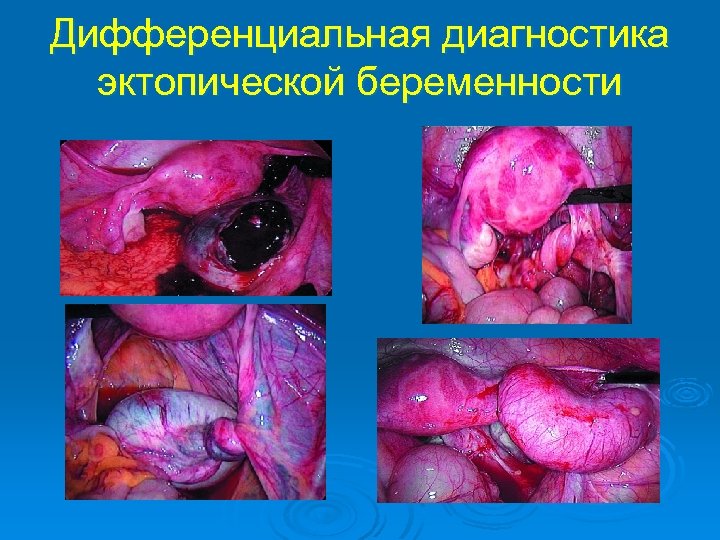Дифференциальная диагностика эктопической беременности 