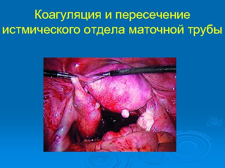 Коагуляция и пересечение истмического отдела маточной трубы 