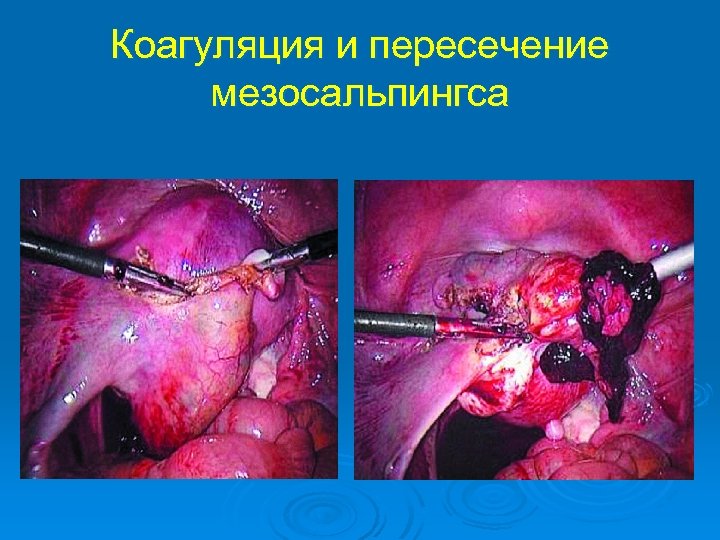 Коагуляция и пересечение мезосальпингса 