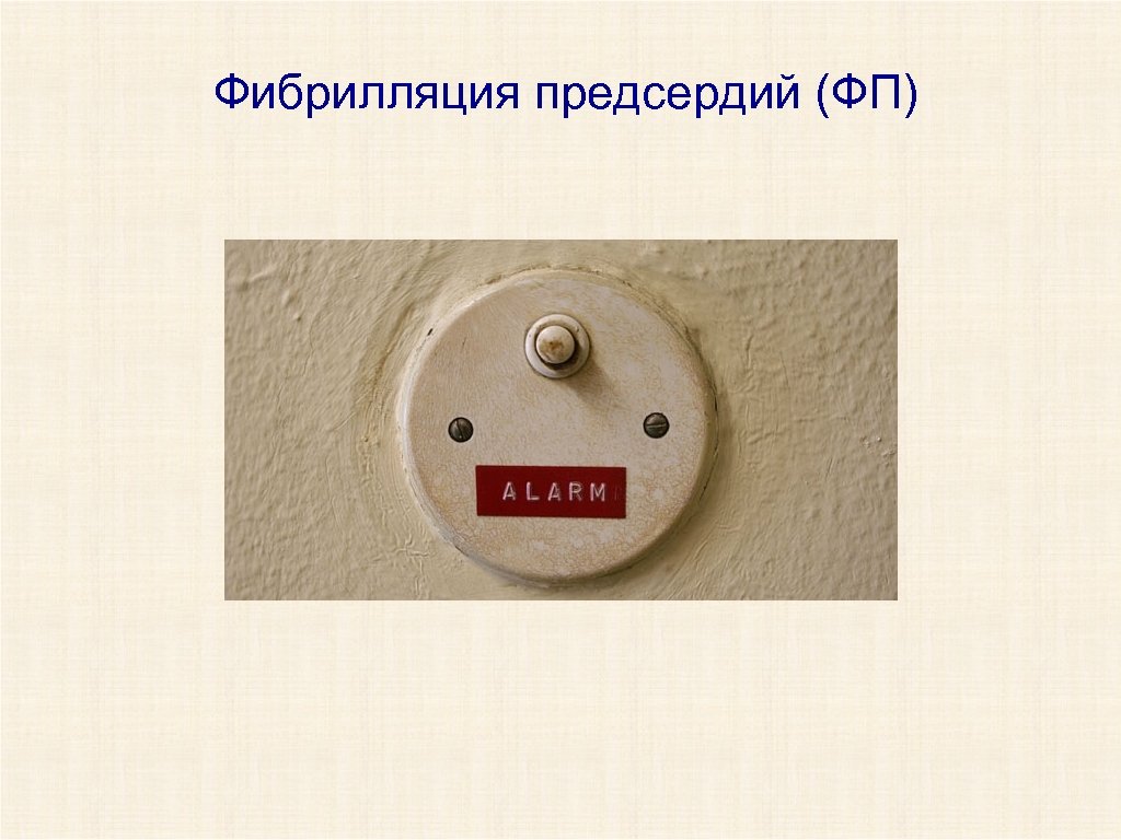 Фибрилляция предсердий (ФП) 