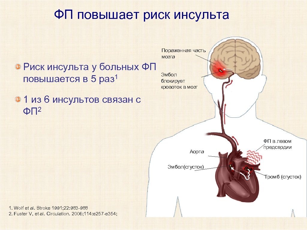 Инсульт сердца. Риск инсульта. Факторы риска инсульта у больных фибрилляцией предсердий. Инсульт связан с сердцем. Факторы риска инсульта у больных ФП.