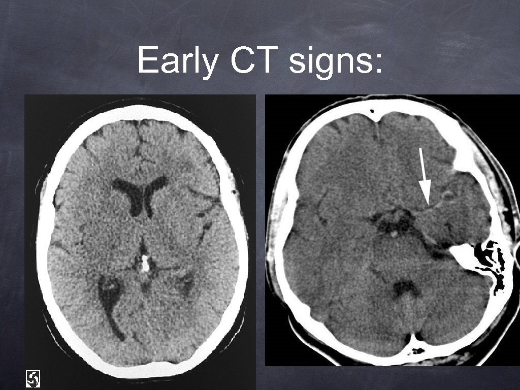 Early CT signs: 