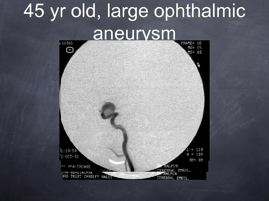 45 yr old, large ophthalmic aneurysm 