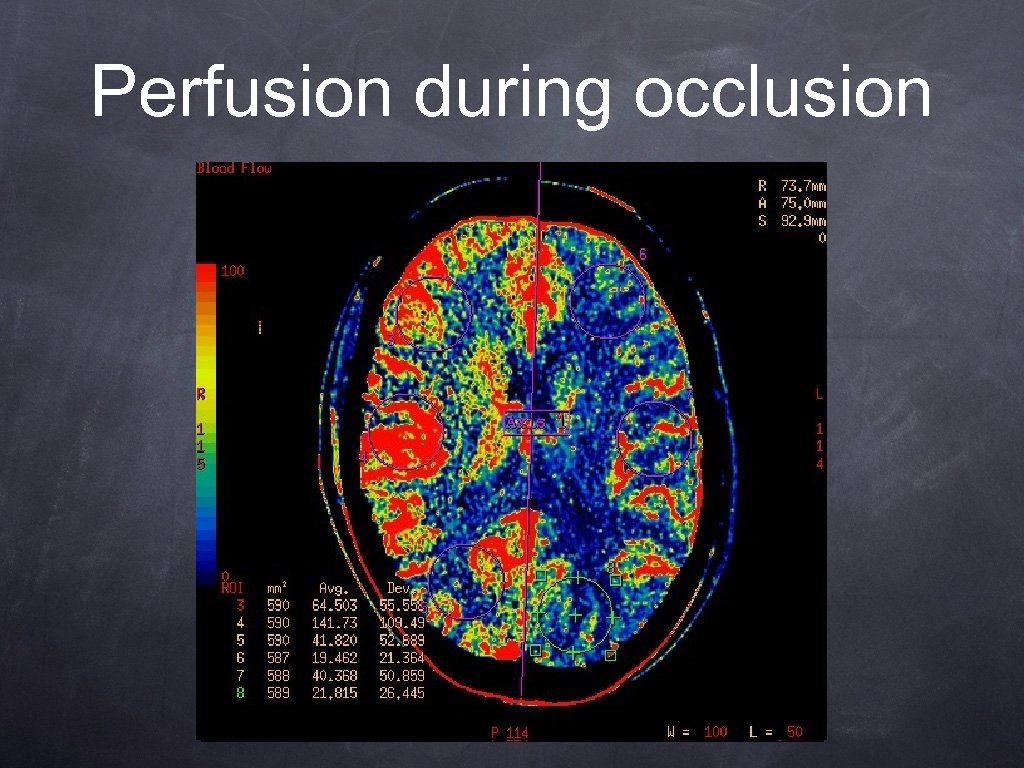 Perfusion during occlusion 