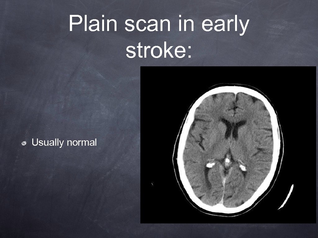 Plain scan in early stroke: Usually normal 