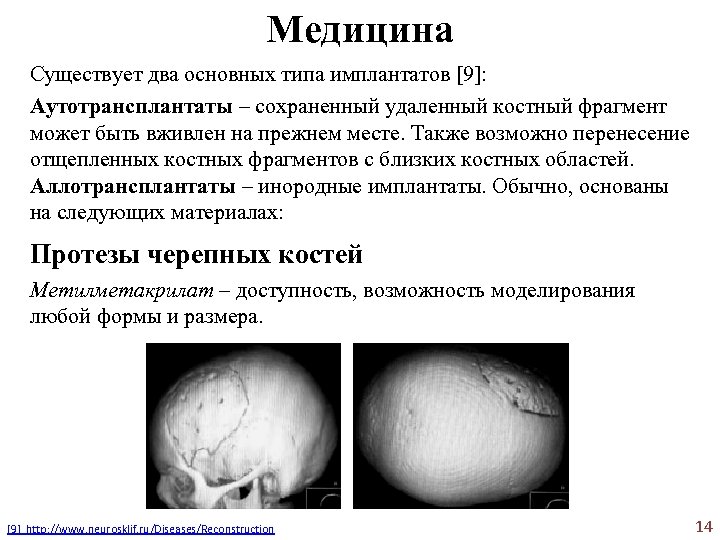 Медицина Существует два основных типа имплантатов [9]: Аутотрансплантаты – сохраненный удаленный костный фрагмент может