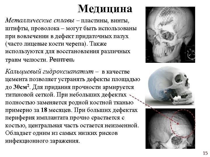 Медицина Металлические сплавы – пластины, винты, штифты, проволока – могут быть использованы при вовлечении